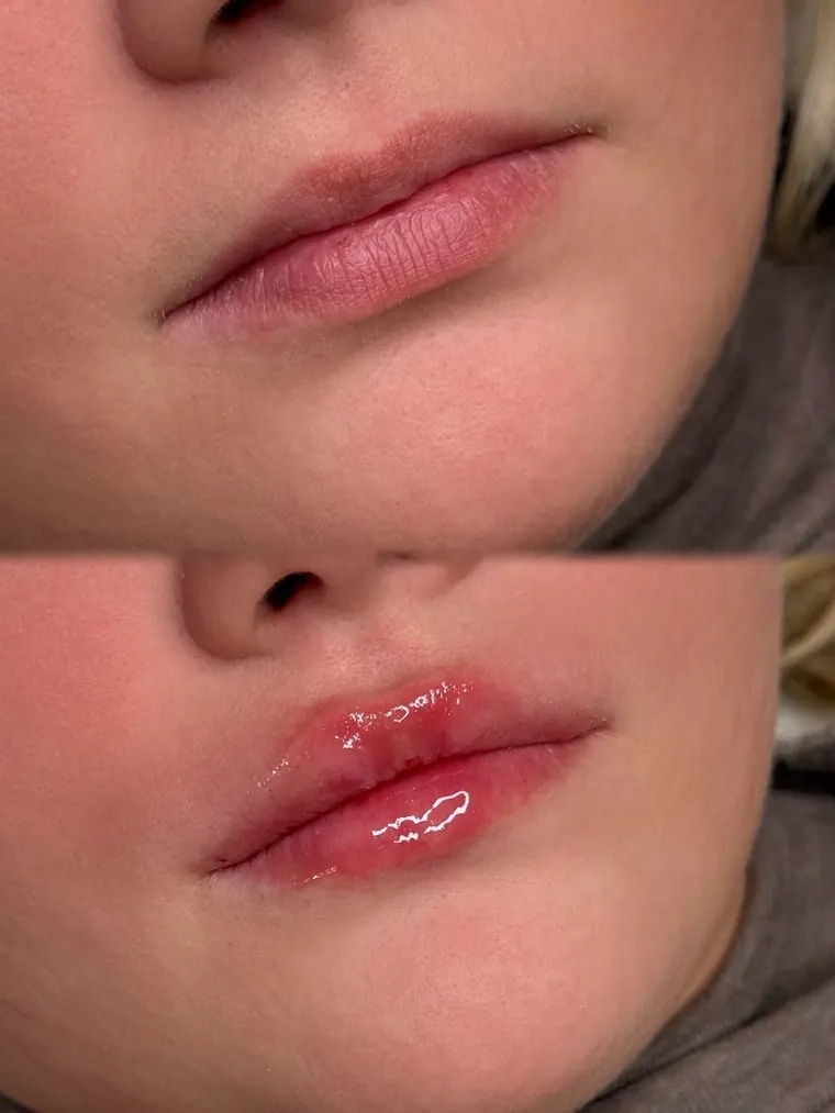 Lippen – Hyaluron bei Miri Beauty